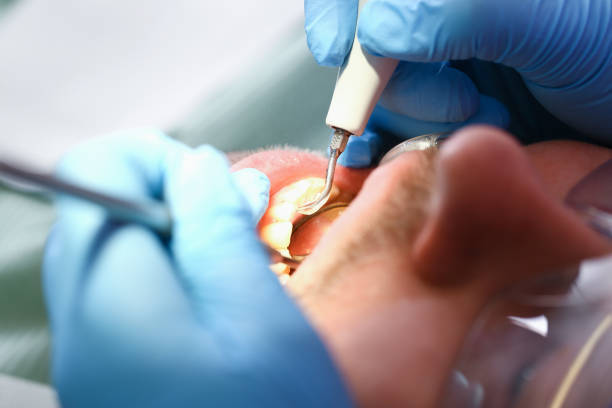 Best Emergency Dentist for Lost Fillings or Crowns in Mountain Home, ID